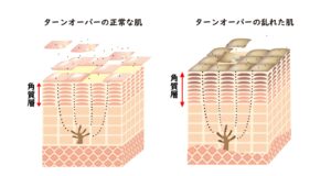 ターンオーバー肌画像