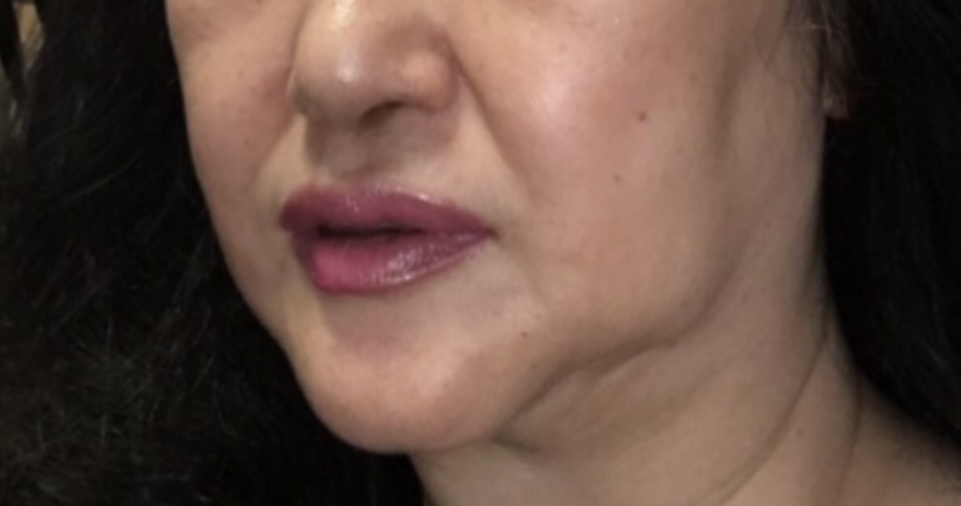 だるだるなフェスライン