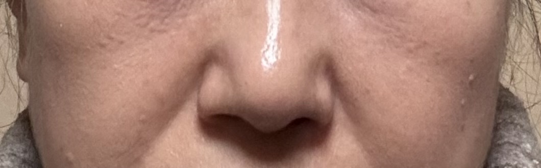 老けて見えるゴルゴライン肌写真