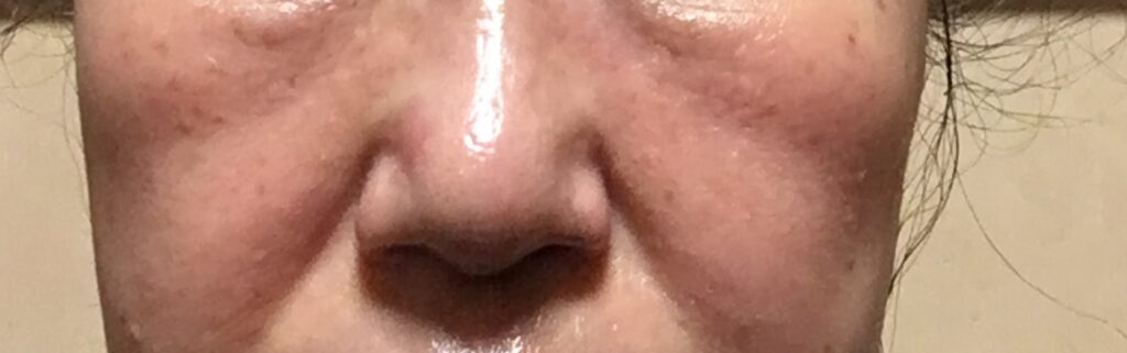 ゴルゴライン肌女性