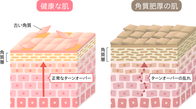 ターンオーバー肌画像