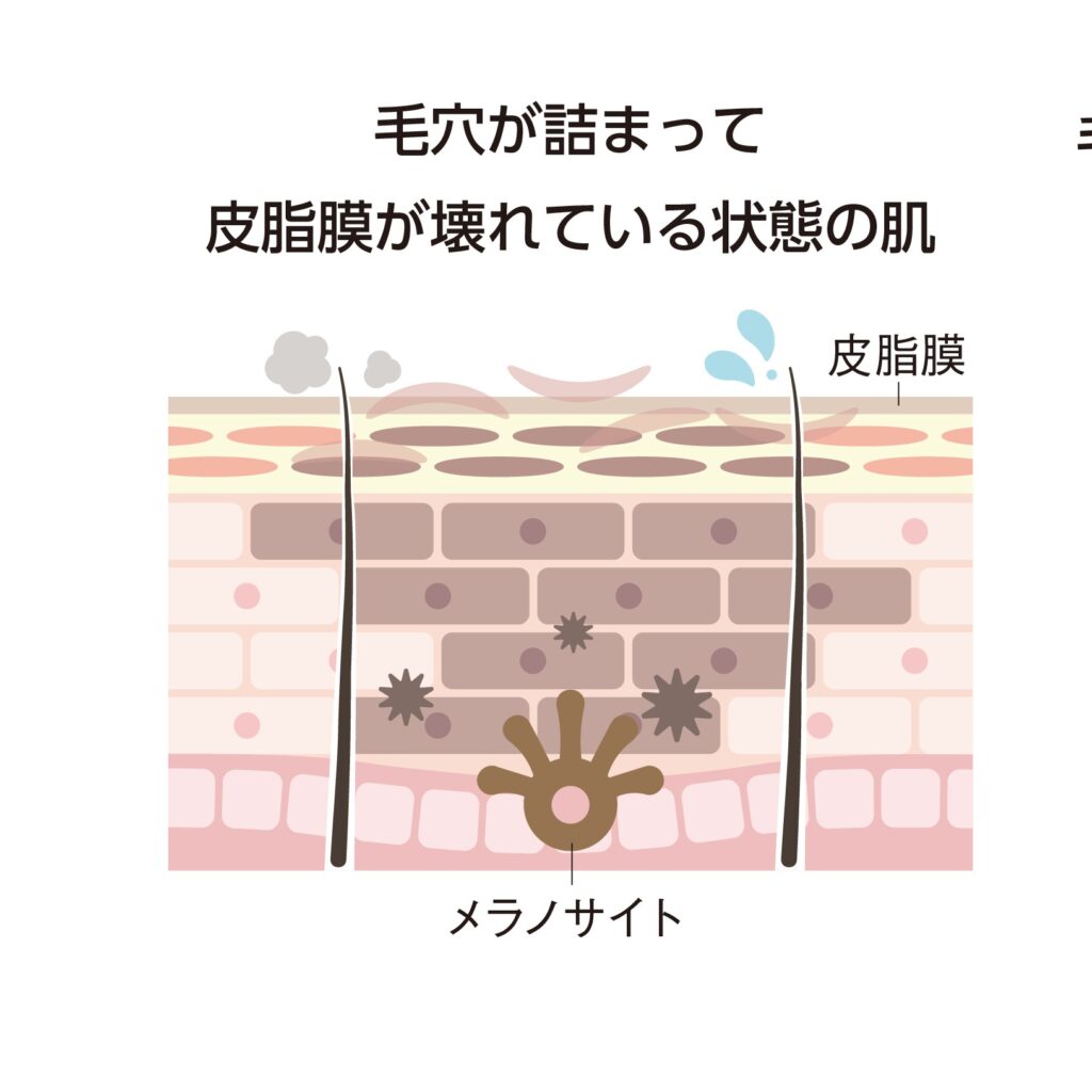 毛穴つまり肌画像